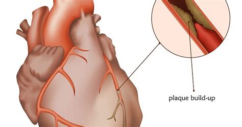 organicdietguide: Cholesterol & Blocked Arteries – Causes and Treatments