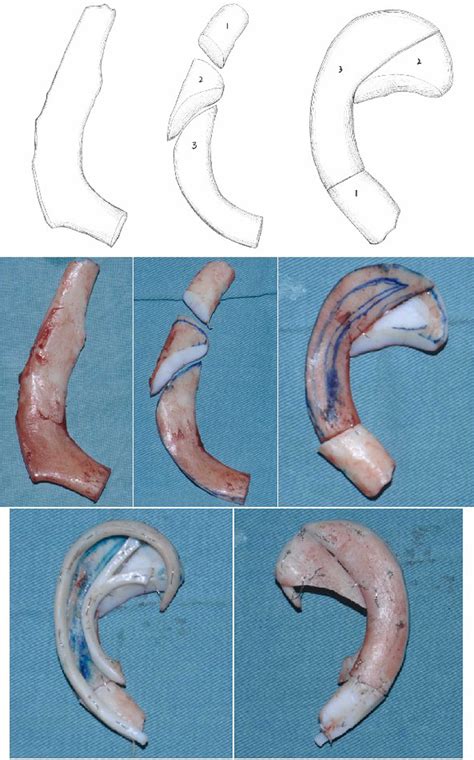 Ear reconstruction stage I: Minor modifications in sculpting the ...