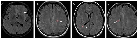 Ms Mri Flair