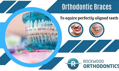 Effective Teeth Alignment Through Orthodontic Braces | by ROCKWOOD ...