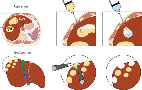 Figure 3 from Medical and surgical treatment options for polycystic liver disease. | Semantic ...