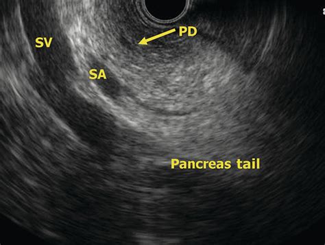 EUS of the Normal Pancreas | Radiology Key