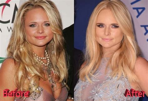 Miranda Lambert Plastic Surgery: More Than Just A Diet