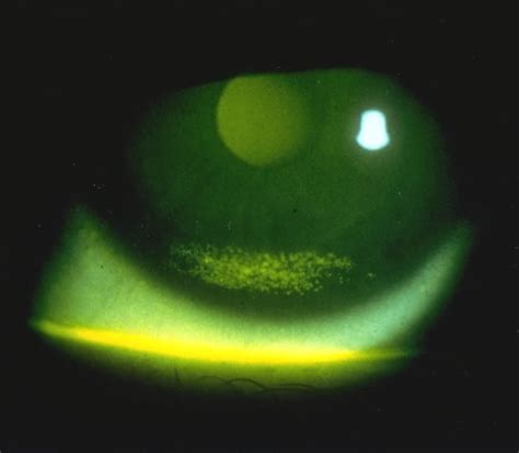 Tricks of the Trade: Fluorescein application techniques for the eye ...