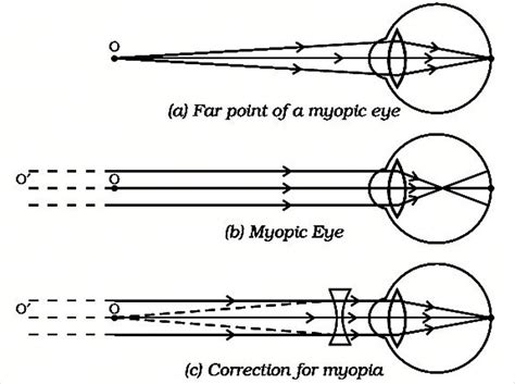 when do we consider a person to be myopic or hypermetropic? draw a ray ...