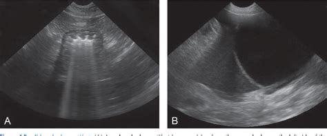 Figure 1.10 from Focused—Basic Ultrasound Principles and Artifacts | Semantic Scholar