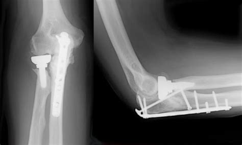 Elbow Fracture Treatment | Elbow Bone Fracture Surgery