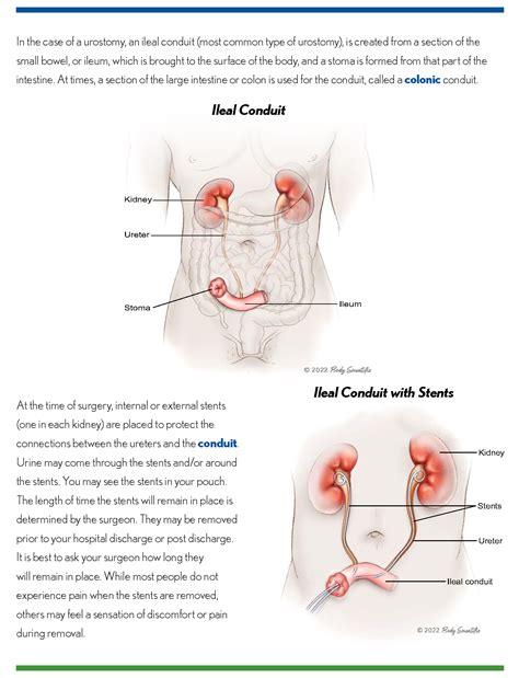 Urostomy Care: How To Care For An Indiana Pouch, Ileal, 50% OFF