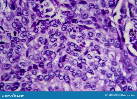 Transitional Cell Carcinoma