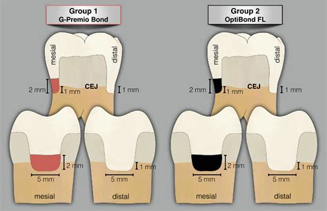 Influence of cervical margin relocation and adhesive system on microleakage of indirect ...