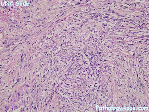 epithelioid sarcoma pathology