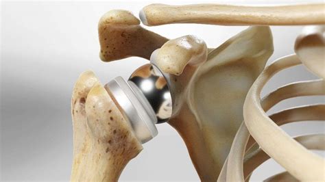 Reverse Total Shoulder Replacement - California Orthopaedic Specialists