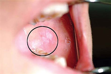 Adjunctive techniques for mouth cancer screening – Dentistry Online | Dental Jay