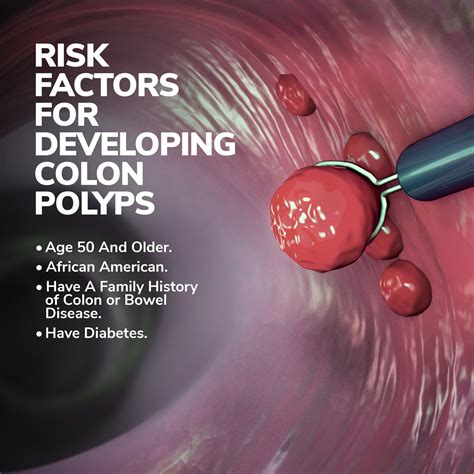 What are Polyps? | Gastroenterology of Greater Orlando