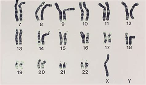 Difference Between Monosomy and Trisomy | Definition, Facts, Examples and Differences