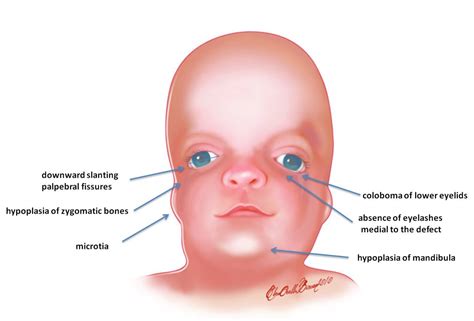 My Notes for USMLE — Treacher Collins & DiGeorge Syndromes 1st and...