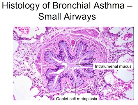 Asthma Histology