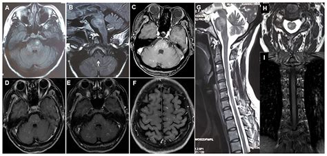 Frontiers | Area Postrema Syndrome: A Rare Feature of Chronic Lymphocytic Inflammation With ...