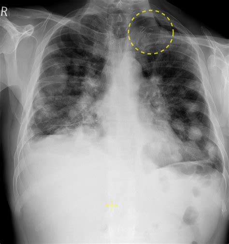 Lung metastases from head and neck cancer - Radiology at St. Vincent's ...