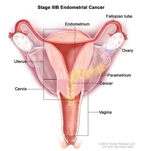 Endometrial Cancer Treatment - NCI