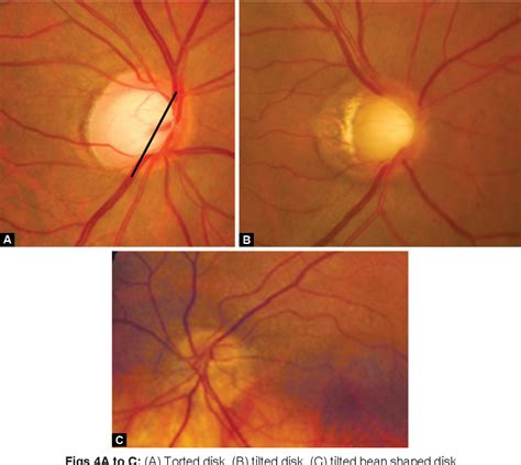 Figure 2 from Evaluation of the Optic Nerve Head in Glaucoma | Semantic Scholar