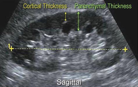 Renal Ultrasound | Radiology Key