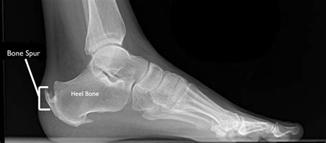 Achilles Tendinitis - OrthoInfo - AAOS