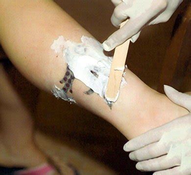 Tattoo Removal Cream: The Future of Tattoo Removal?