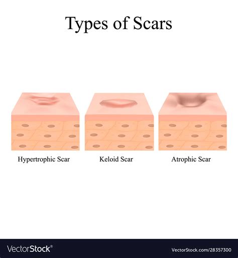 Types scars acne scars keloid hypertrophic Vector Image