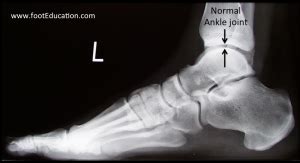 Ankle Arthritis - FootEducation