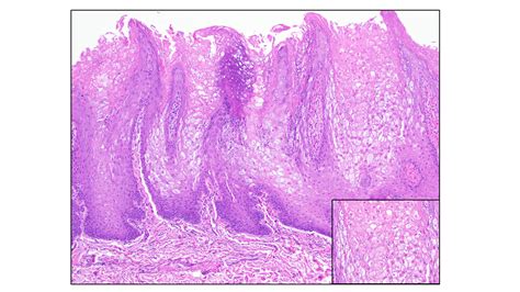 Oral | Free Full-Text | White Sponge Nevus, a Rare but Important Entity