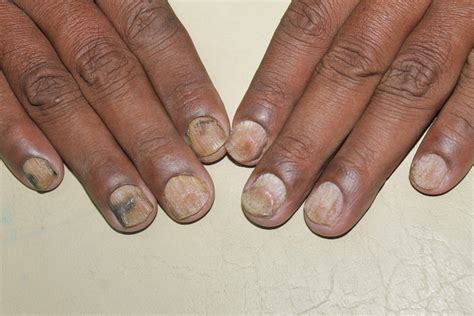 Nail Psoriasis Could Find Help With Homeopathy