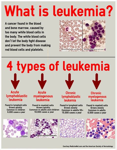 leukemia - Google Search | Leukemia | Pinterest | Google search, Google and Medical