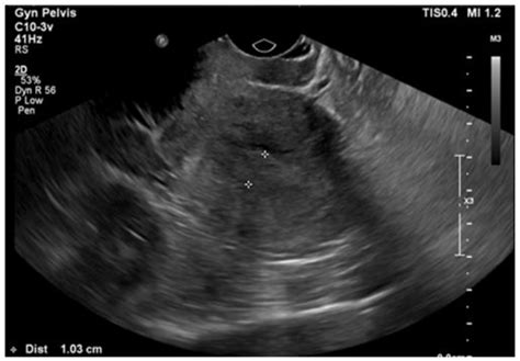 Thickened Endometrium on Transvaginal Ultrasound. | Download Scientific ...