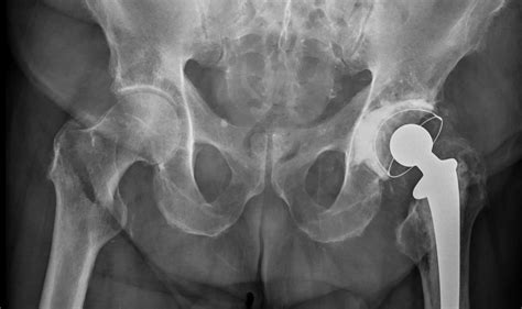 Hip fractures may increase death risk in senior citizens | Agency-Wire