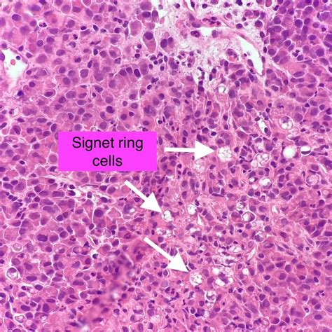 Details 68+ signet ring cell carcinoma latest - vova.edu.vn