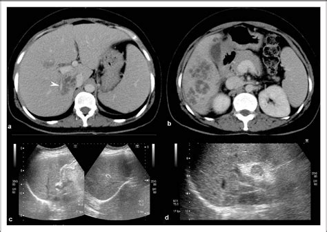 Figure 1 from Visceral larva migrans presenting as multiple liver abscesses | Semantic Scholar