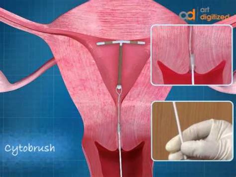 Intra Uterine Device (IUD) CopperT Animation | ADMAA - YouTube