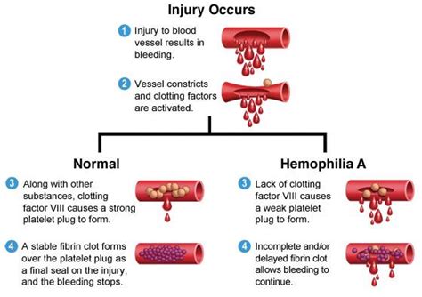 hemophilia | Nursing Mnemonics and memory aids | Pinterest | Mothers and It is