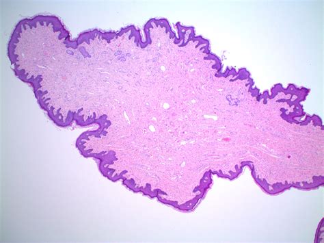 Fibroepithelial Polyp Histology