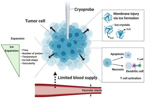 Recent progress in cryoablation cancer therapy and nanoparticles ...