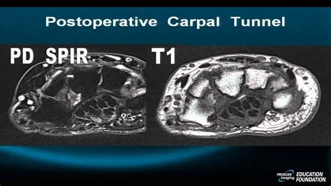 [View 32+] Download Carpal Tunnel Syndrome Mri Radiology Background jpg