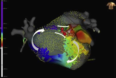 Cardiac Mapping Systems - Cardiac Electrophysiology Clinics