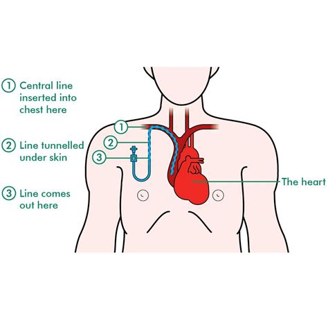 Central lines - Information and support | Hematology nursing, Central line, Hickman