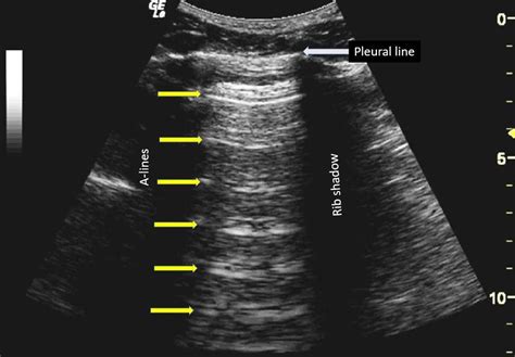 COVID-19 and the Role of Point of Care Ultrasound