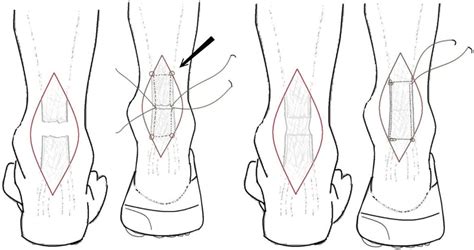 The pictures depict two conditions seen intraoperatively. If the tendon ...