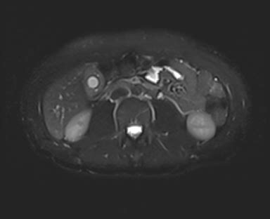 Gallbladder adenomyomatosis | Image | Radiopaedia.org