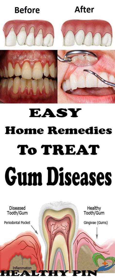 Home Remedies for Gum Disease.. #oralgumremedies | Gum disease treatment, Gum health, Gum ...