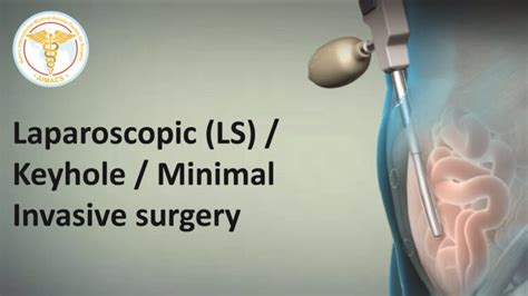 Recovery after Laparoscopic Inguinal / Groin hernia surgery. What to ...