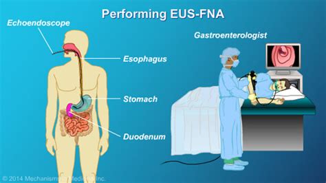 Understanding EUS-FNA